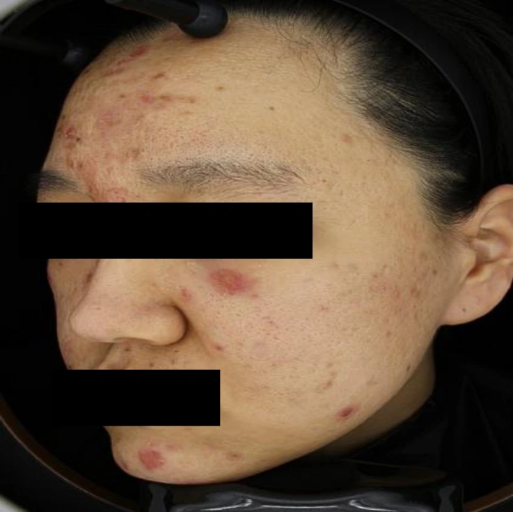 Skin boosters for acne scars: cheek views at Samsung B&S Clinic. Samsung B&S Clinic, Seoul — skin boosters for acne scars: cheek views, before treatment.