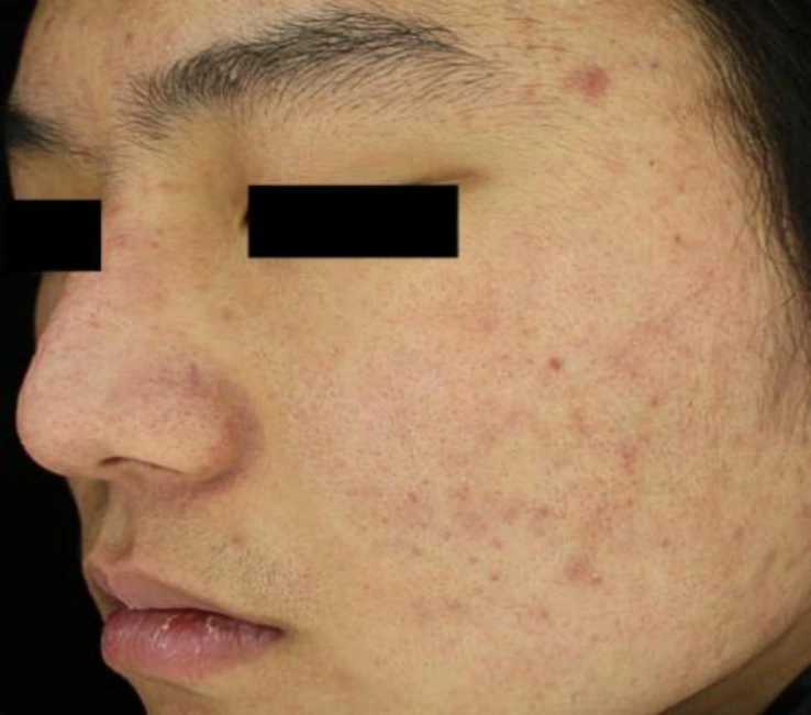 Skin boosters for acne scars: cheek views at Samsung B&S Clinic. Samsung B&S Clinic, Seoul — skin boosters for acne scars: cheek views, after treatment (additional cheek view).