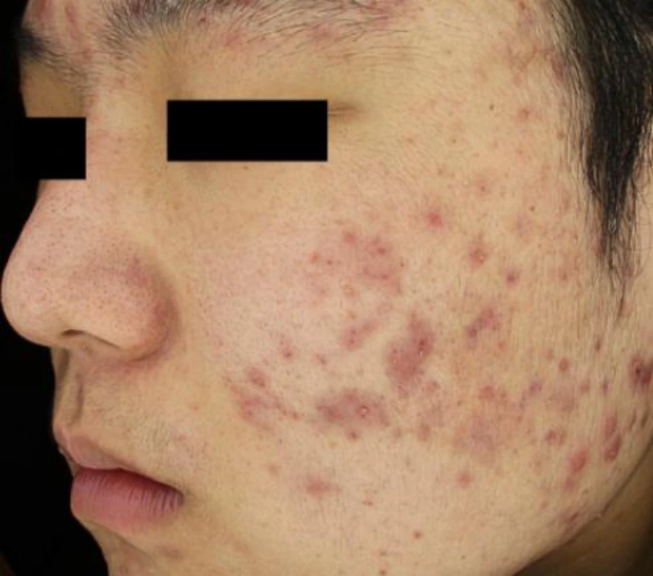 Skin boosters for acne scars: cheek views at Samsung B&S Clinic. Samsung B&S Clinic, Seoul — skin boosters for acne scars: cheek views, before treatment (additional cheek view).
