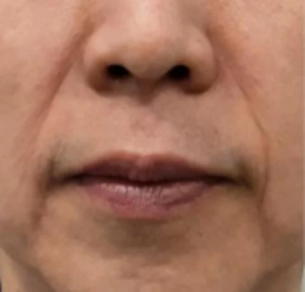 Skin boosters and autologous blood filler: three sessions at Samsung B&S Clinic. Samsung B&S Clinic, Seoul — skin boosters and autologous blood filler: three sessions, before treatment.