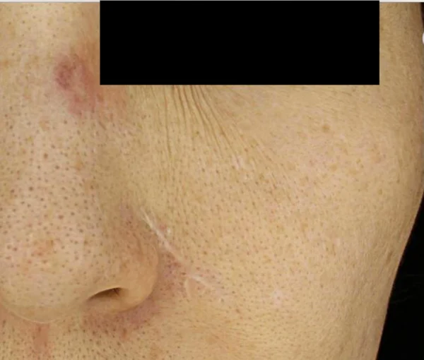 Skin boosters for post-shingles scarring: two sessions at Samsung B&S Clinic. Samsung B&S Clinic, Seoul — skin boosters for post-shingles scarring: two sessions, before treatment.