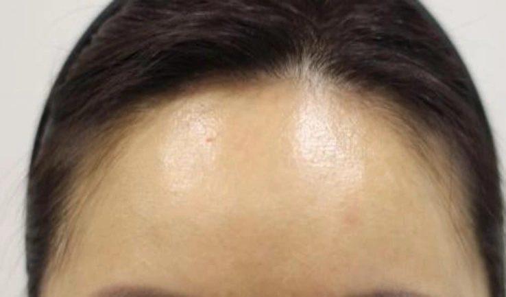 Forehead filler: upper-forehead comparison at Samsung B&S Clinic. Samsung B&S Clinic, Seoul — forehead filler: upper-forehead comparison, after treatment.