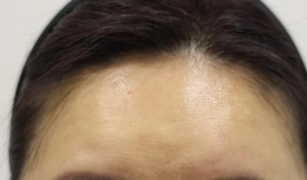 Forehead filler: upper-forehead comparison at Samsung B&S Clinic. Samsung B&S Clinic, Seoul — forehead filler: upper-forehead comparison, before treatment.
