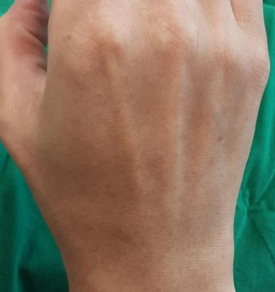 Hand filler: 3 cc per hand at Samsung B&S Clinic. Samsung B&S Clinic, Seoul — hand filler: 3 cc per hand, before treatment.