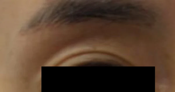 Eyelid filler: brow-to-lid close-up at Samsung B&S Clinic. Samsung B&S Clinic, Seoul — eyelid filler: brow-to-lid close-up, before treatment.
