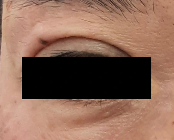 Eyelid filler: upper-lid contour comparison at Samsung B&S Clinic. Samsung B&S Clinic, Seoul — eyelid filler: upper-lid contour comparison, after treatment.
