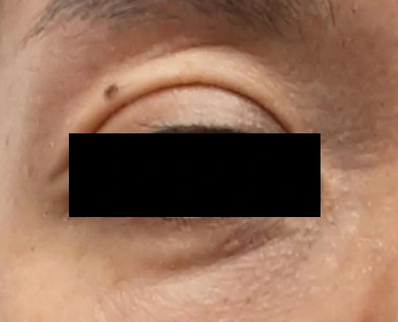 Eyelid filler: upper-lid contour comparison at Samsung B&S Clinic. Samsung B&S Clinic, Seoul — eyelid filler: upper-lid contour comparison, before treatment.