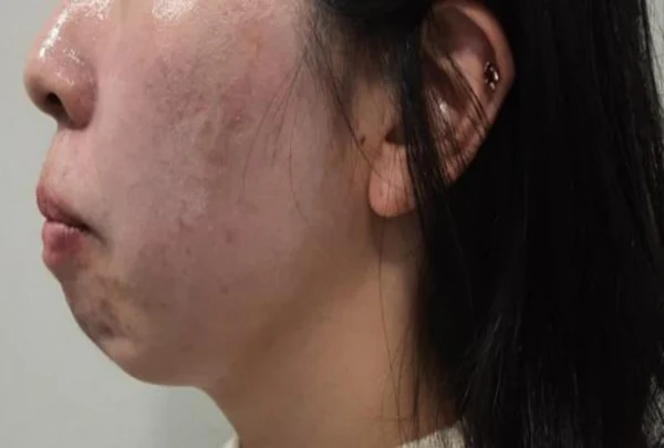 Chin filler: side-view contour at Samsung B&S Clinic. Samsung B&S Clinic, Seoul — chin filler: side-view contour, before treatment.