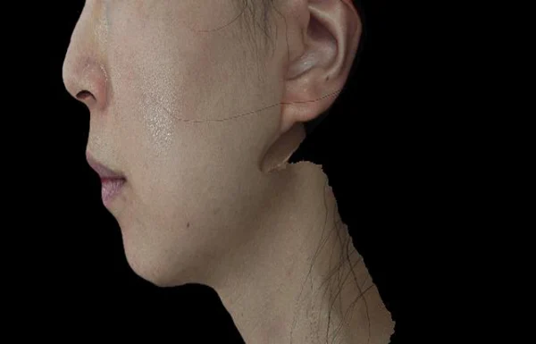 Ellansé: cheek and lower-face profile at Samsung B&S Clinic. Samsung B&S Clinic, Seoul — ellansé: cheek and lower-face profile, before treatment.
