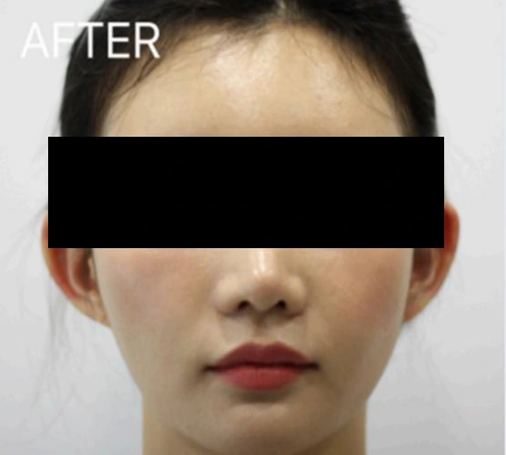 Ear-volume filler: front-facing comparison at Samsung B&S Clinic. Samsung B&S Clinic, Seoul — ear-volume filler: front-facing comparison, after treatment.