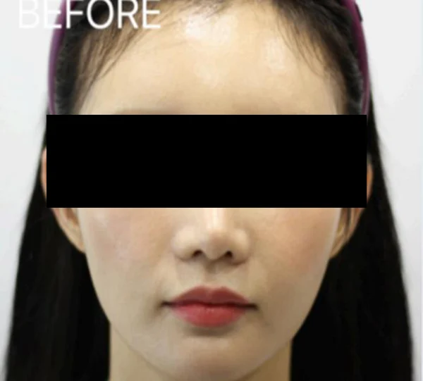 Ear-volume filler: front-facing comparison at Samsung B&S Clinic. Samsung B&S Clinic, Seoul — ear-volume filler: front-facing comparison, before treatment.