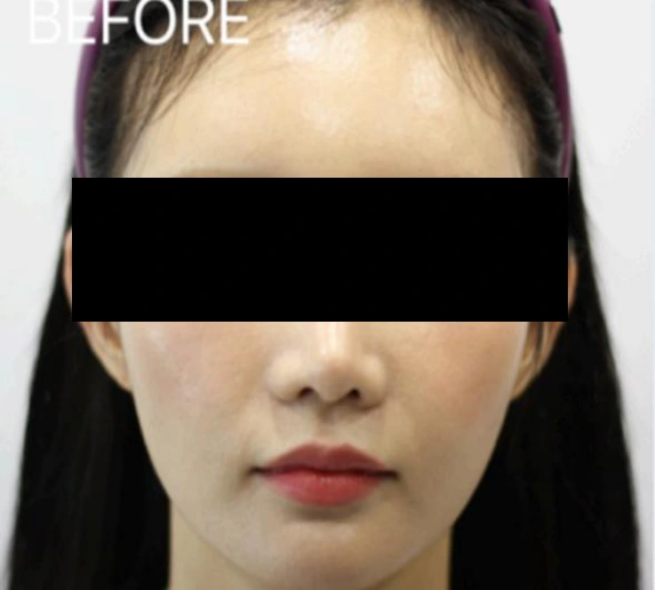 Ear-volume filler: front-facing comparison at Samsung B&S Clinic. Samsung B&S Clinic, Seoul — ear-volume filler: front-facing comparison, before treatment.