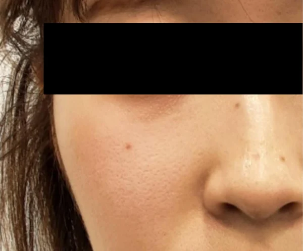 Ear-volume filler: cheek-side crop at Samsung B&S Clinic. Samsung B&S Clinic, Seoul — ear-volume filler: cheek-side crop, before treatment.