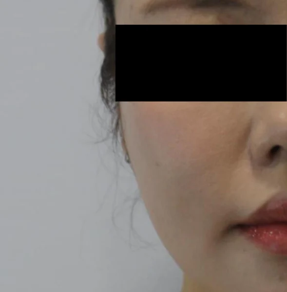 Ear-volume filler: narrow front view at Samsung B&S Clinic. Samsung B&S Clinic, Seoul — ear-volume filler: narrow front view, before treatment.