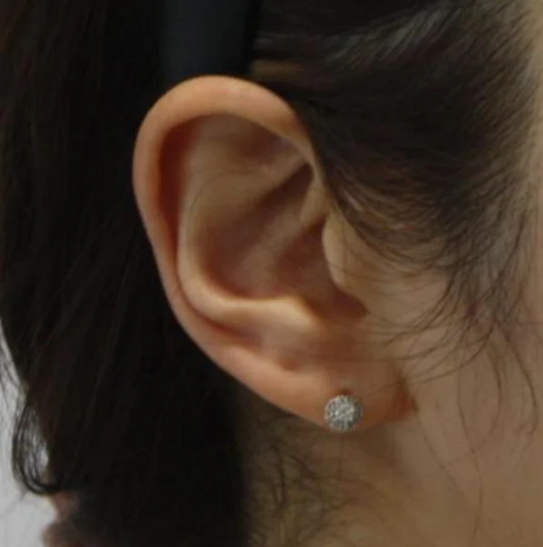 Ear-volume filler: ear and hairline profile at Samsung B&S Clinic. Samsung B&S Clinic, Seoul — ear-volume filler: ear and hairline profile, before treatment.
