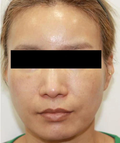 Ear-volume filler: bilateral front view at Samsung B&S Clinic. Samsung B&S Clinic, Seoul — ear-volume filler: bilateral front view, before treatment.