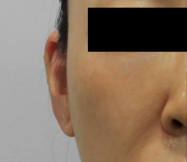 Ear-volume filler: oblique facial view at Samsung B&S Clinic. Samsung B&S Clinic, Seoul — ear-volume filler: oblique facial view, after treatment.