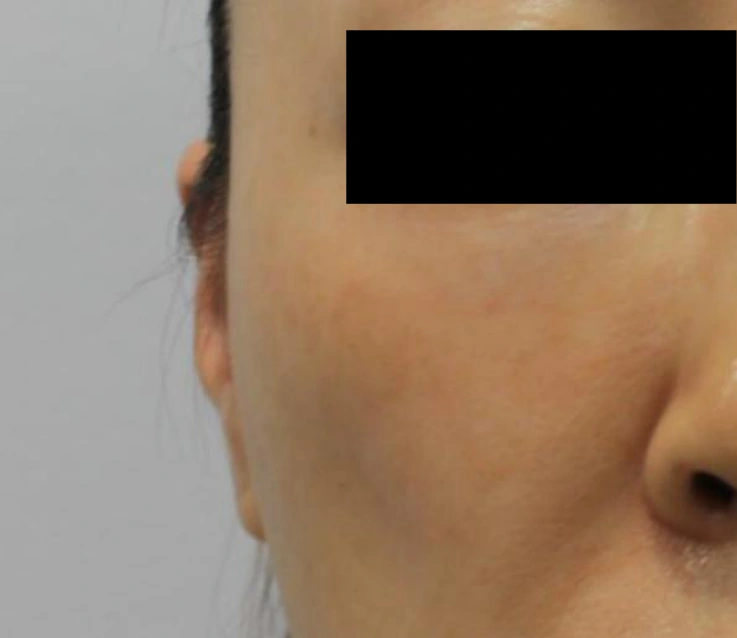 Ear-volume filler: oblique facial view at Samsung B&S Clinic. Samsung B&S Clinic, Seoul — ear-volume filler: oblique facial view, before treatment.