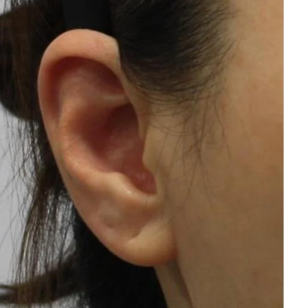 Ear-volume filler: close-up of the outer ear at Samsung B&S Clinic. Samsung B&S Clinic, Seoul — ear-volume filler: close-up of the outer ear, before treatment.