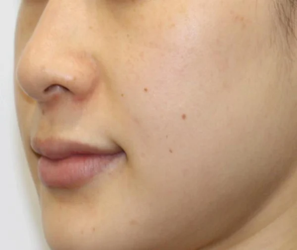 Cheek filler: oblique midface views at Samsung B&S Clinic. Samsung B&S Clinic, Seoul — cheek filler: oblique midface views, before treatment.