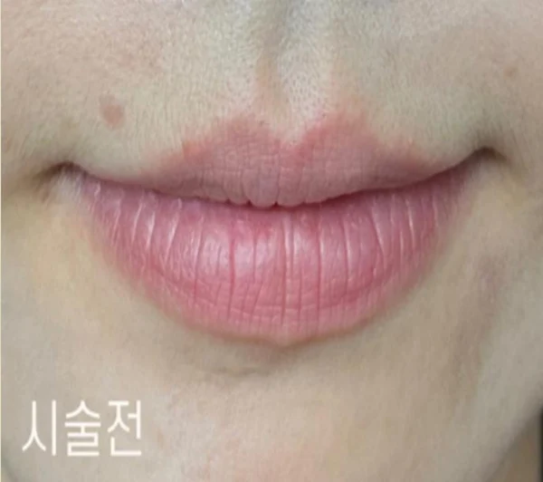 Lip filler: before and immediately after at Samsung B&S Clinic. Samsung B&S Clinic, Seoul — lip filler: before and immediately after, before treatment.