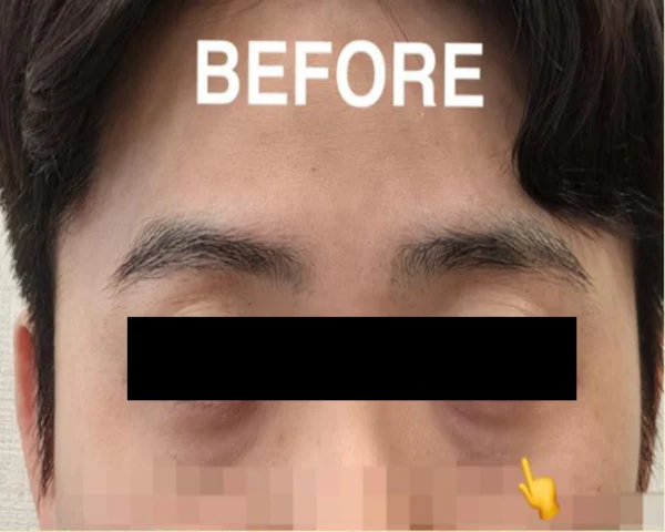 Tear-trough filler: under-eye and cheek view at Samsung B&S Clinic. Samsung B&S Clinic, Seoul — tear-trough filler: under-eye and cheek view, before treatment.