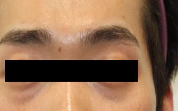 Tear-trough filler: close-up comparison at Samsung B&S Clinic. Samsung B&S Clinic, Seoul — tear-trough filler: close-up comparison, before treatment.