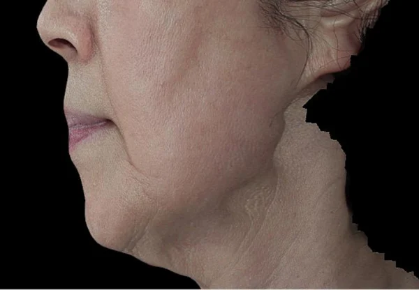 Ulthera for the double-chin area at Samsung B&S Clinic. Samsung B&S Clinic, Seoul — ulthera for the double-chin area, before treatment.