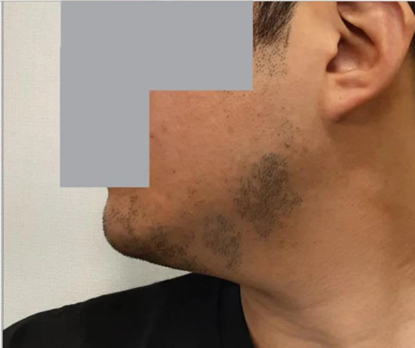 Ulthera, V-OLET and Botox: jawline comparison at Samsung B&S Clinic. Samsung B&S Clinic, Seoul — ulthera, v-olet and botox: jawline comparison, before treatment.