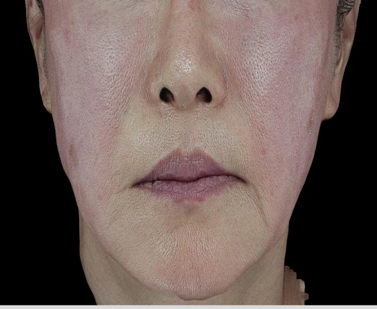 Radiofrequency lifting: lower-face comparison at Samsung B&S Clinic. Samsung B&S Clinic, Seoul — radiofrequency lifting: lower-face comparison, after treatment.