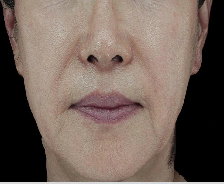 Radiofrequency lifting: lower-face comparison at Samsung B&S Clinic. Samsung B&S Clinic, Seoul — radiofrequency lifting: lower-face comparison, before treatment.