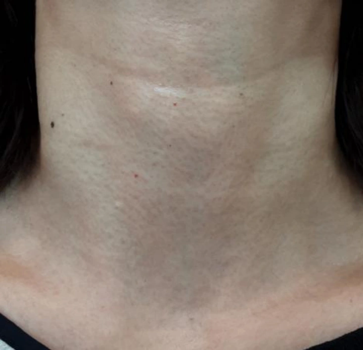 Radiesse for horizontal neck lines at Samsung B&S Clinic. Samsung B&S Clinic, Seoul — radiesse for horizontal neck lines, after treatment.