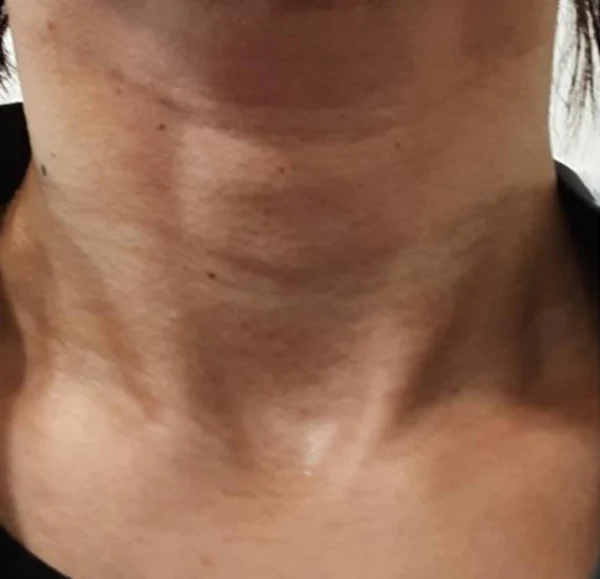 Radiesse for horizontal neck lines at Samsung B&S Clinic. Samsung B&S Clinic, Seoul — radiesse for horizontal neck lines, before treatment.