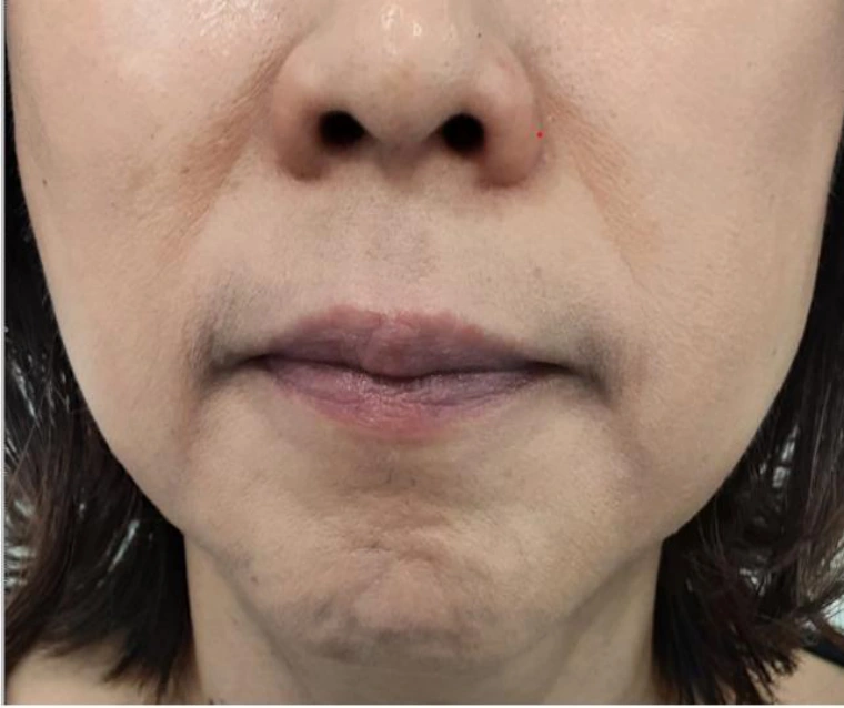 Radiesse around the mouth at Samsung B&S Clinic. Samsung B&S Clinic, Seoul — radiesse around the mouth, after treatment.