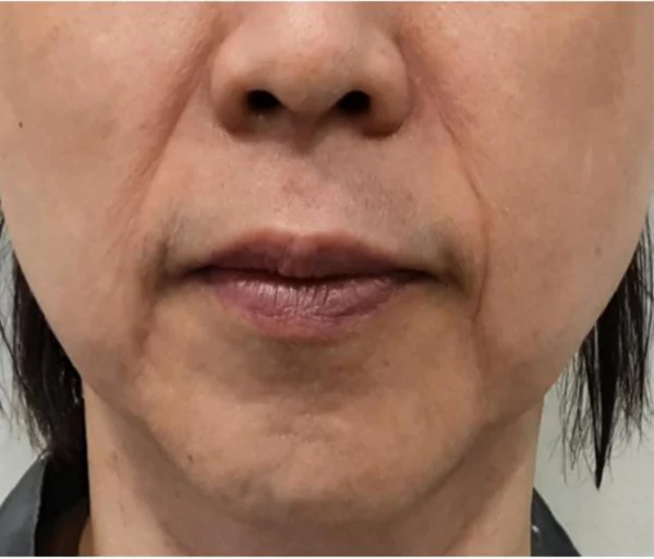 Radiesse around the mouth at Samsung B&S Clinic. Samsung B&S Clinic, Seoul — radiesse around the mouth, before treatment.