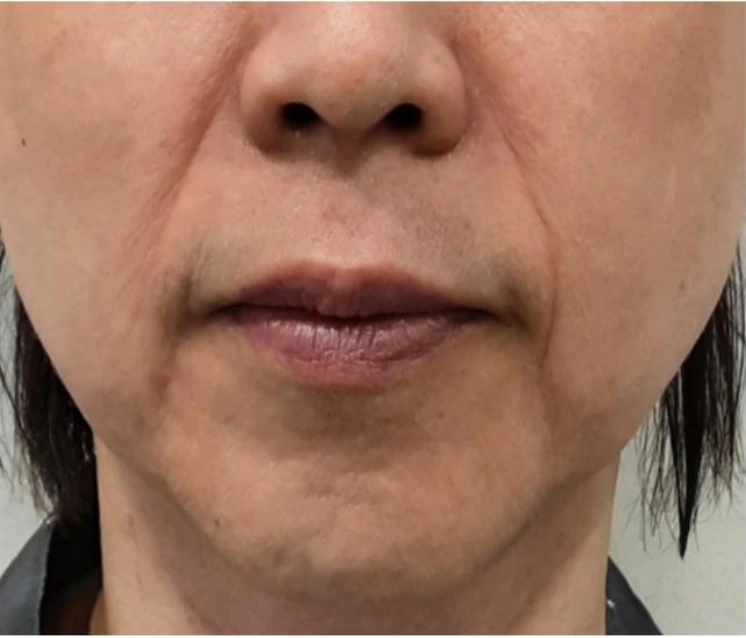Radiesse around the mouth at Samsung B&S Clinic. Samsung B&S Clinic, Seoul — radiesse around the mouth, before treatment.