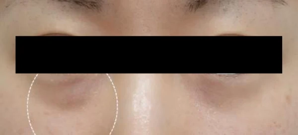 UltraCol for under-eye hollowness and dark circles at Samsung B&S Clinic. Samsung B&S Clinic, Seoul — ultracol for under-eye hollowness and dark circles, before treatment.
