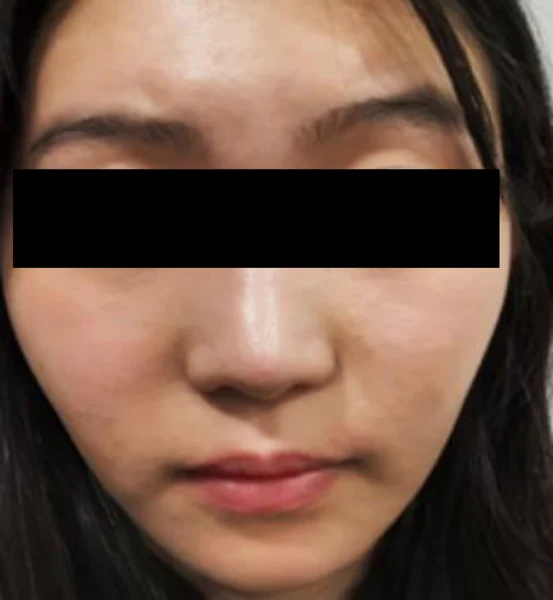 Juvelook: full-face comparison at Samsung B&S Clinic. Samsung B&S Clinic, Seoul — juvelook: full-face comparison, before treatment.