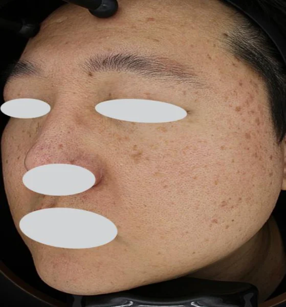 Pigmentation treatment: angled cheek views at Samsung B&S Clinic. Samsung B&S Clinic, Seoul — pigmentation treatment: angled cheek views, before treatment.