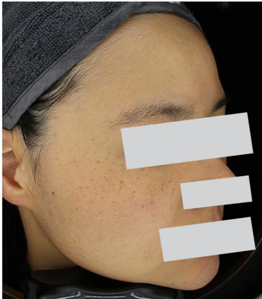 Pigmentation laser: oblique facial comparison at Samsung B&S Clinic. Samsung B&S Clinic, Seoul — pigmentation laser: oblique facial comparison, before treatment.