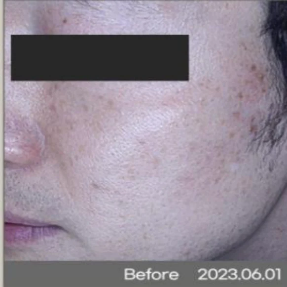 Pigmentation laser: dated cheek comparison at Samsung B&S Clinic. Samsung B&S Clinic, Seoul — pigmentation laser: dated cheek comparison, before treatment.