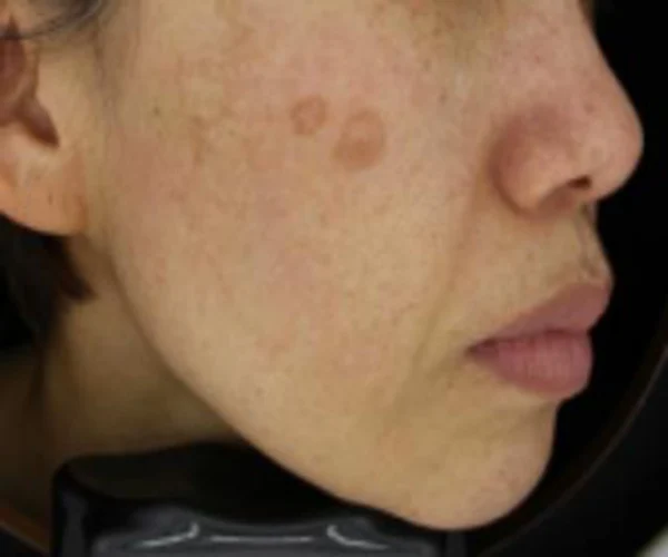 Large pigmented lesion: cheek comparison at Samsung B&S Clinic. Samsung B&S Clinic, Seoul — large pigmented lesion: cheek comparison, before treatment.