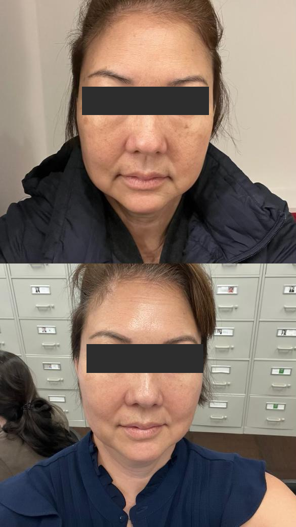 A combined facial treatment comparison before and after at SeoJeong Dermatology