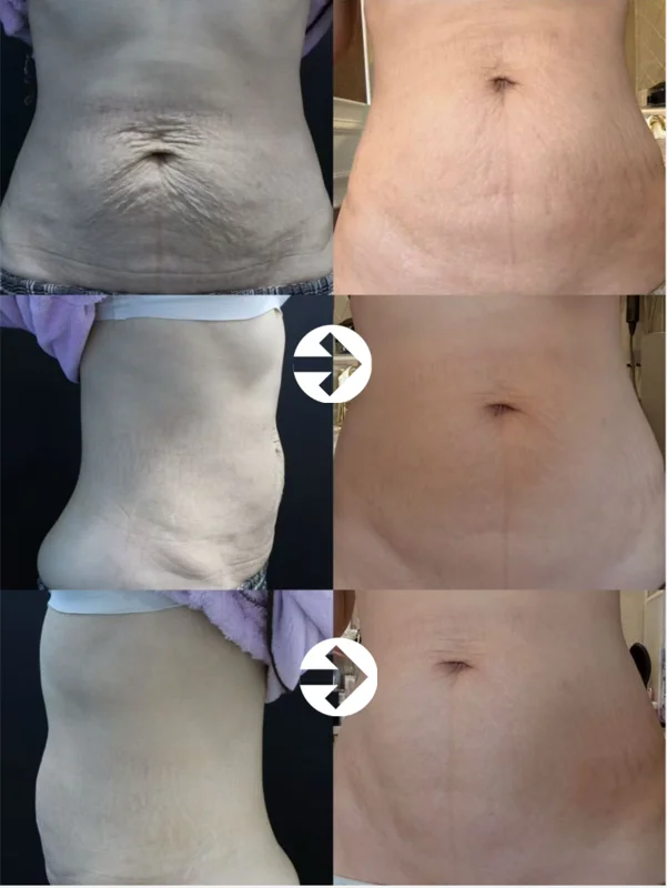 Abdominal skin: multiple-view comparison at Seolreim Clinic. Abdominal skin: multiple-view comparison. The caption describes the arrangement of the earlier and later views. Eyes retain the clinic’s supplied privacy coverings where visible. Follow-up timing is not supplied.