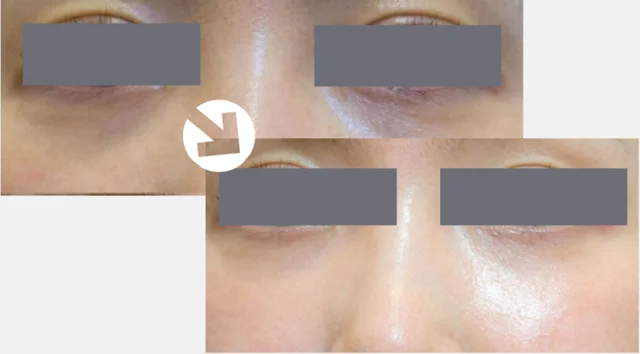 Baby Collagen Injection: close under-eye views at Seolreim Clinic. Baby Collagen Injection: close under-eye views. The caption describes the arrangement of the earlier and later views. Eyes retain the clinic’s supplied privacy coverings where visible. Follow-up timing is not supplied.