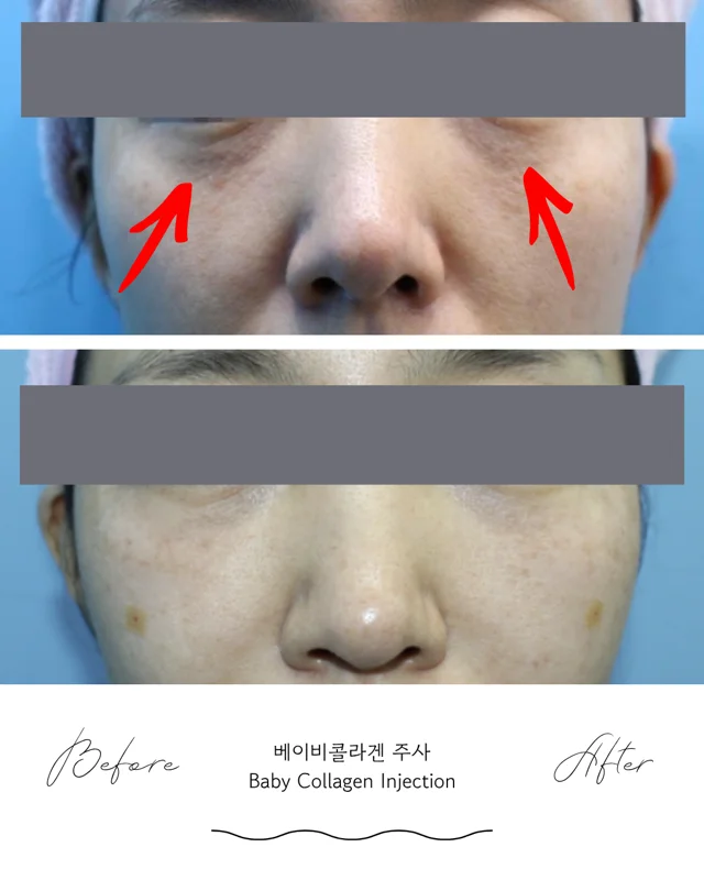 Baby Collagen Injection: under-eye comparison at Seolreim Clinic. Baby Collagen Injection: under-eye comparison. The caption describes the arrangement of the earlier and later views. Eyes retain the clinic’s supplied privacy coverings where visible. Follow-up timing is not supplied.