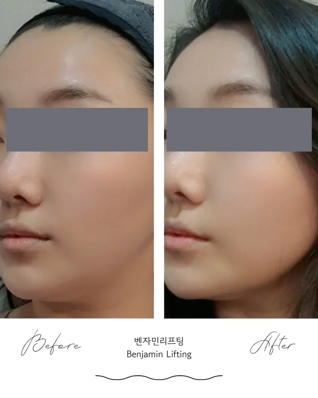 Benjamin Lifting: angled and front views at Seolreim Clinic. Benjamin Lifting: angled and front views. Before on the left and after on the right. Eyes retain the clinic’s supplied privacy coverings where visible. Follow-up timing is not supplied.