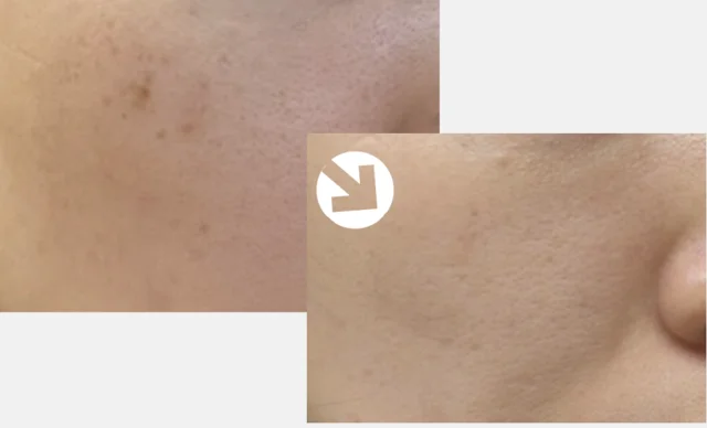 Excel V: cheek skin comparison at Seolreim Clinic. Excel V: cheek skin comparison. The caption describes the arrangement of the earlier and later views. Eyes retain the clinic’s supplied privacy coverings where visible. Follow-up timing is not supplied.