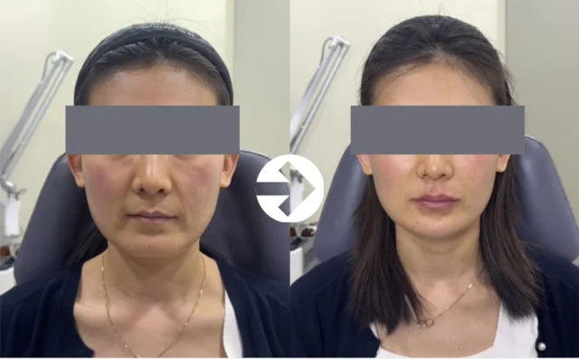 Facial comparison 1: cheeks and jawline at Seolreim Clinic. Facial comparison 1: cheeks and jawline. The caption describes the arrangement of the earlier and later views. Eyes retain the clinic’s supplied privacy coverings where visible. Follow-up timing is not supplied.