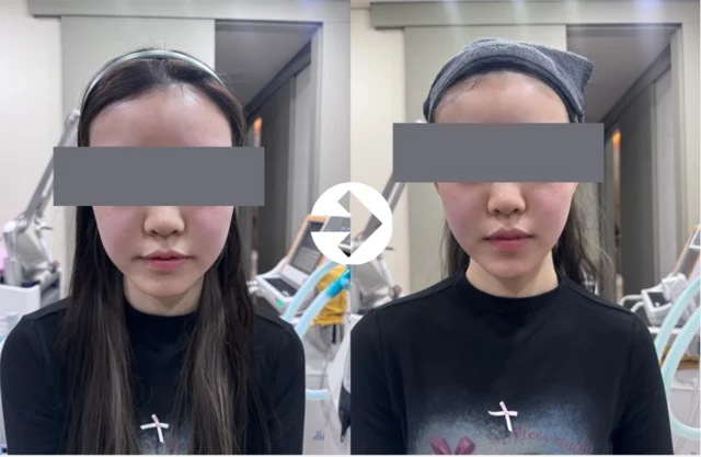 Facial comparison 2: lower-face contours at Seolreim Clinic. Facial comparison 2: lower-face contours. The caption describes the arrangement of the earlier and later views. Eyes retain the clinic’s supplied privacy coverings where visible. Follow-up timing is not supplied.